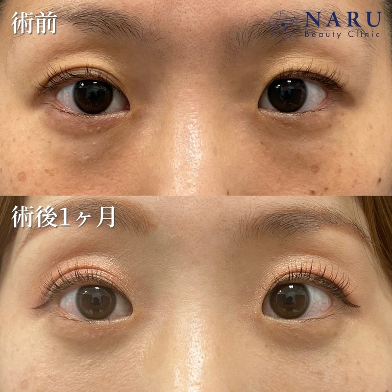 公式サイトの症例（切らないクマ取り・30代女性の術前と術後1ヶ月・2例目）