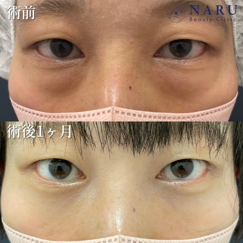 公式サイトの症例（切らないクマ取り・30代女性の術前と術後1ヶ月・3例目）