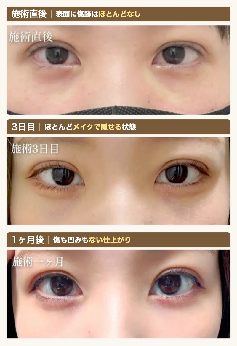 施術直後・3日目・1ヶ月後の経過(傷跡ほぼなし・メイクで隠せる・傷も凹みもなし)